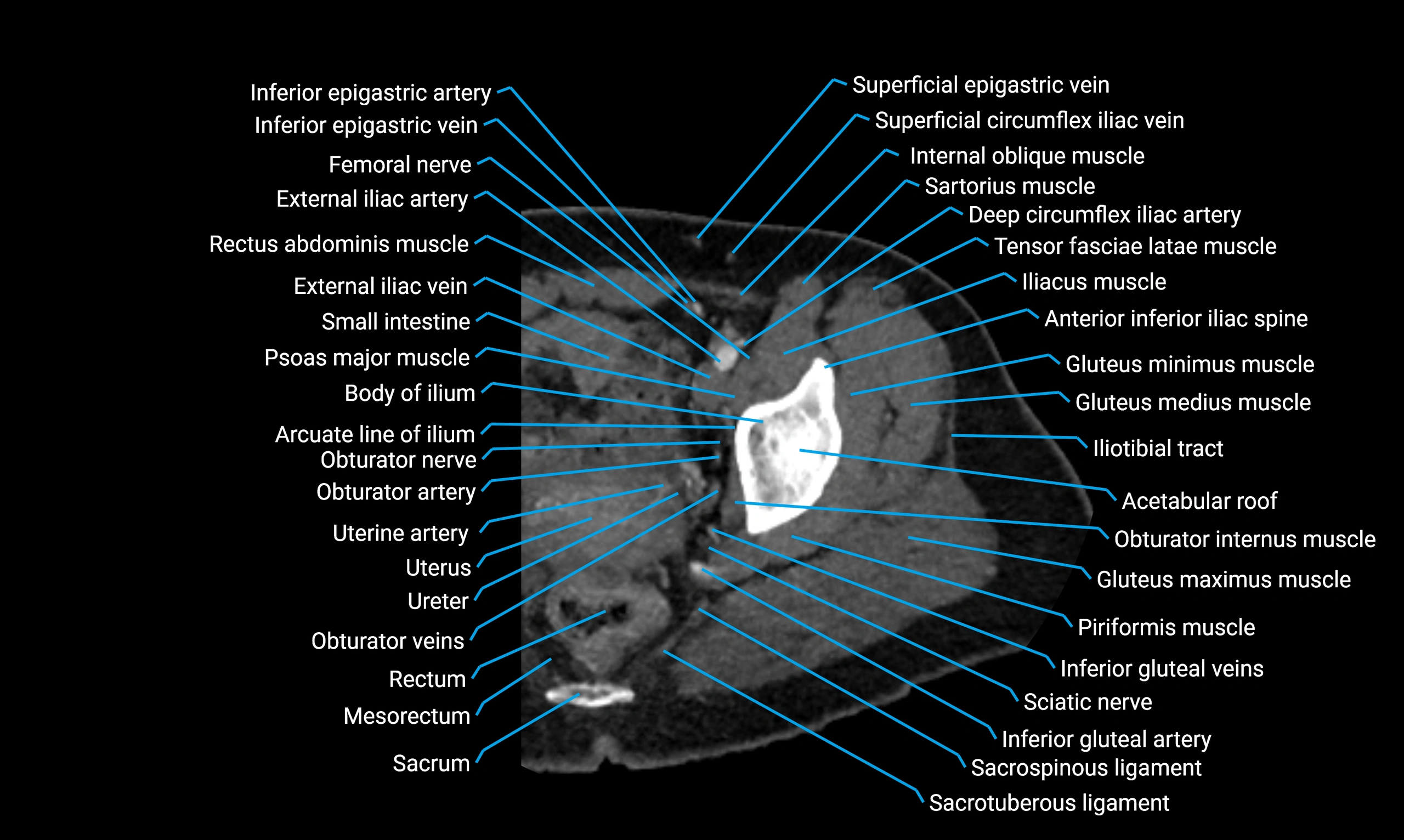 CT lower limb axial cross sectional anatomy labelled image 2 (2).webp